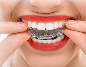 Invisalign Clear Aligner Cost In Mumbai